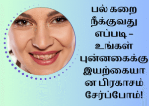 பல் கறை நீக்குவது எப்படி
