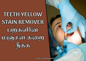 Teeth Yellow Stain Remover | பற்களின் மஞ்சள் கறை நீக்க