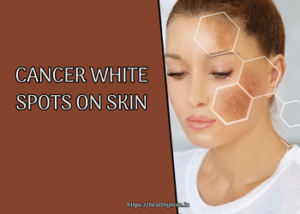 Cancer White Spots on Skin
