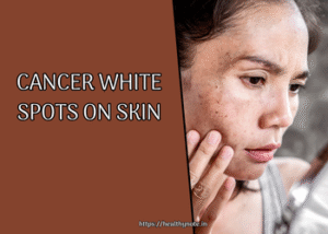 Cancer White Spots on Skin