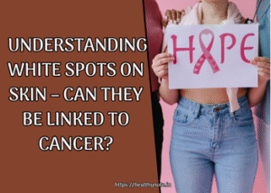 Understanding White Spots on Skin – Can They Be Linked to Cancer