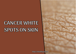 Cancer White Spots on Skin