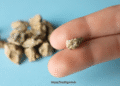 Kidney Stone 4mm Size