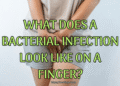 What Does a Bacterial Infection Look Like on a Finger?