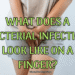 What Does a Bacterial Infection Look Like on a Finger?