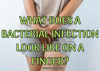 What Does a Bacterial Infection Look Like on a Finger?