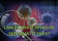 Cancer White Spots on Skin.What it does