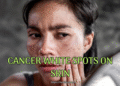 Cancer White Spots on Skin