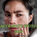 Cancer White Spots on Skin